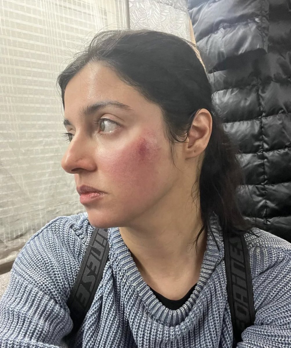 #DivyaKhoslaKumar is beaten by someone in London during film shooting.