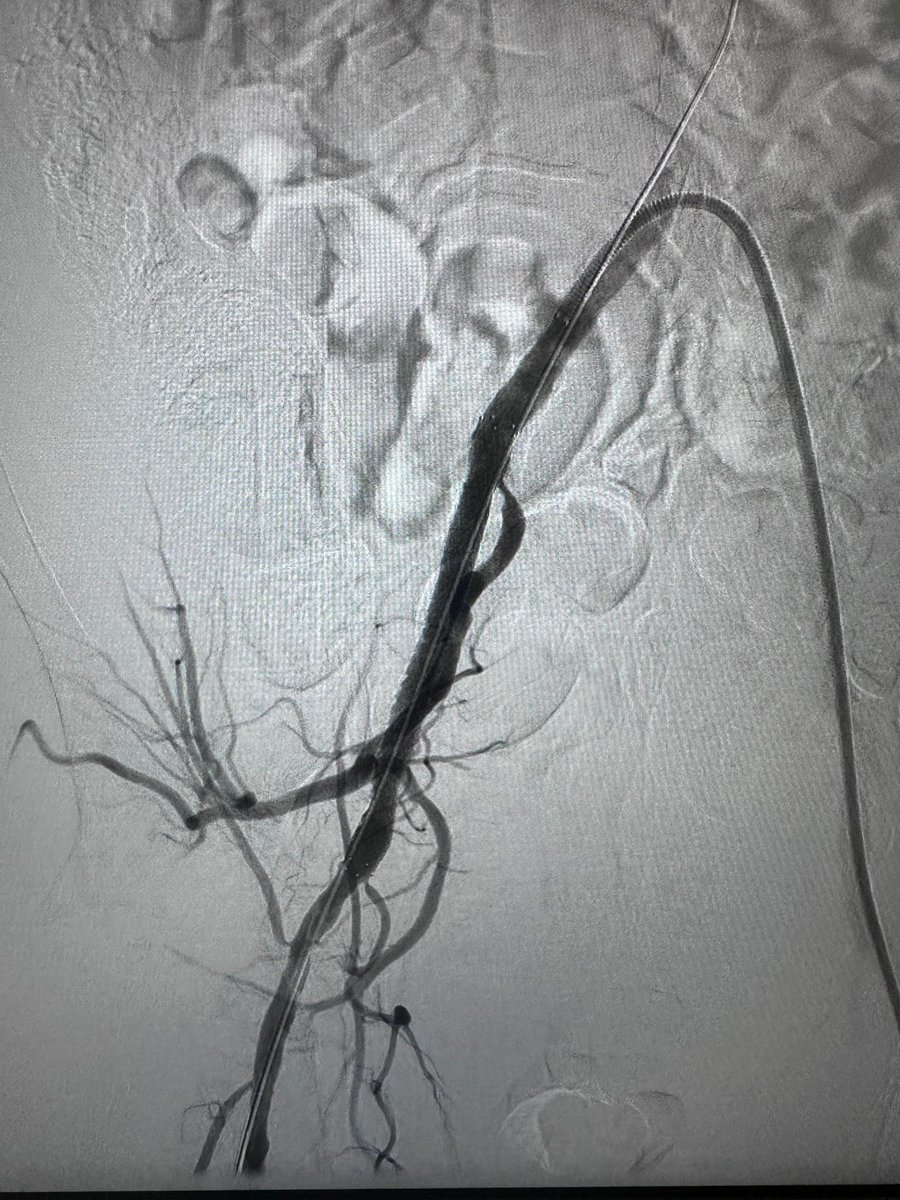 MafbrasilBrasil's tweet photo. Lifestyle limiting Claudication. Agility, precision and a lot of knowledge are essential at this time.#intervention #IC #peripheralvascular @nonewusername1 #TheBest https://t.co/0hXFdvk1EN