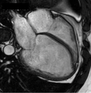 BSCImaging's tweet photo. 🥁Our monthly webinars are back! 
⏲️March 22nd, 5pm
🎤 Dr Paz (Upsana) Tayal, MRC Clinician Scientist, National Heart and Lung Institute, Imperial College London
🫀The role of imaging in Dilated Cardiomyopathy
 Click 👇 to join!
https://t.co/b1uJFwCnLk 
#whycmr #yescct https://t.co/BYIjcWGquA