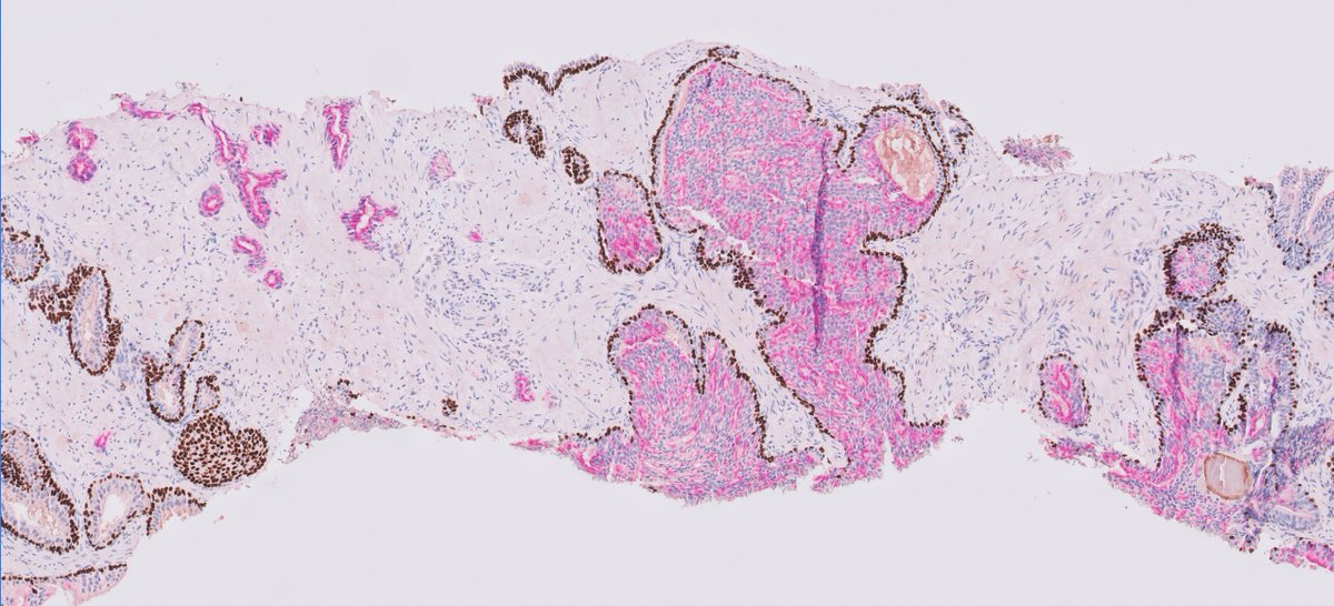 Not a diagnostic challenge in #gupath 
#pathology