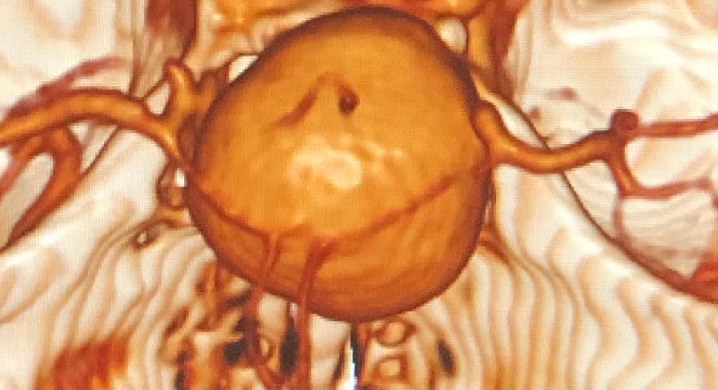 CRADdiagnostics's tweet photo. This is a giant internal carotid artery aneurysm. It was diagnosed using CT angiography in a patient who had headaches and changes in eye sight. CT angiography is used to study blood vessels in different parts of the body. #diagnosticcenterinjos
☎️ 08146844470 https://t.co/CLNxijnOBO