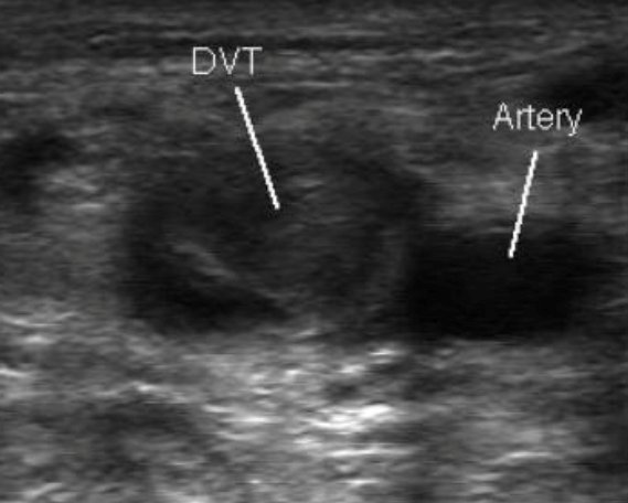 NBTPhysSci's tweet photo. Vascular Scientists routinely diagnose deep vein thrombosis in both arms and legs. Thrombus is clearly visible in the vein and confirmed using compression with the ultrasound probe #HCSWeek2023 #VascularScience https://t.co/Fk2Ff9biAO