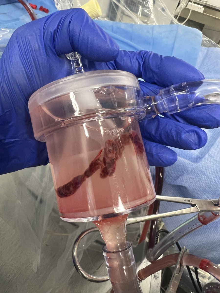 AngioVac is very effective in treating clot this clot in transit. Total time on pump 2 minutes. 26F venous access for Vac and 19F venous return. Have not tried AlphaVac because we have been very successful with this strategy. Is AlphaVac as good, better, or not as powerful?