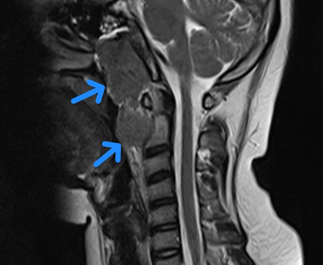 ASK_MSK's tweet photo. 11 yr old, incidental finding on spine MR:
Nasopharyngeal lesion eroding sphenoid sinus, retropharyngeal LN. Multiple enlarged LNs
Initial DD: TB vs neoplasm such as lymphoma
Histo+IHC= nasopharyngeal carcinoma

Learning point: pediatric nasopharyngeal ca (Npca) is 1% of all Npca https://t.co/9hOph8fcER