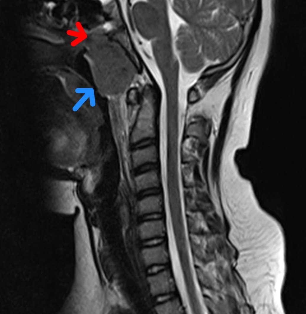 ASK_MSK's tweet photo. 11 yr old, incidental finding on spine MR:
Nasopharyngeal lesion eroding sphenoid sinus, retropharyngeal LN. Multiple enlarged LNs
Initial DD: TB vs neoplasm such as lymphoma
Histo+IHC= nasopharyngeal carcinoma

Learning point: pediatric nasopharyngeal ca (Npca) is 1% of all Npca https://t.co/9hOph8fcER