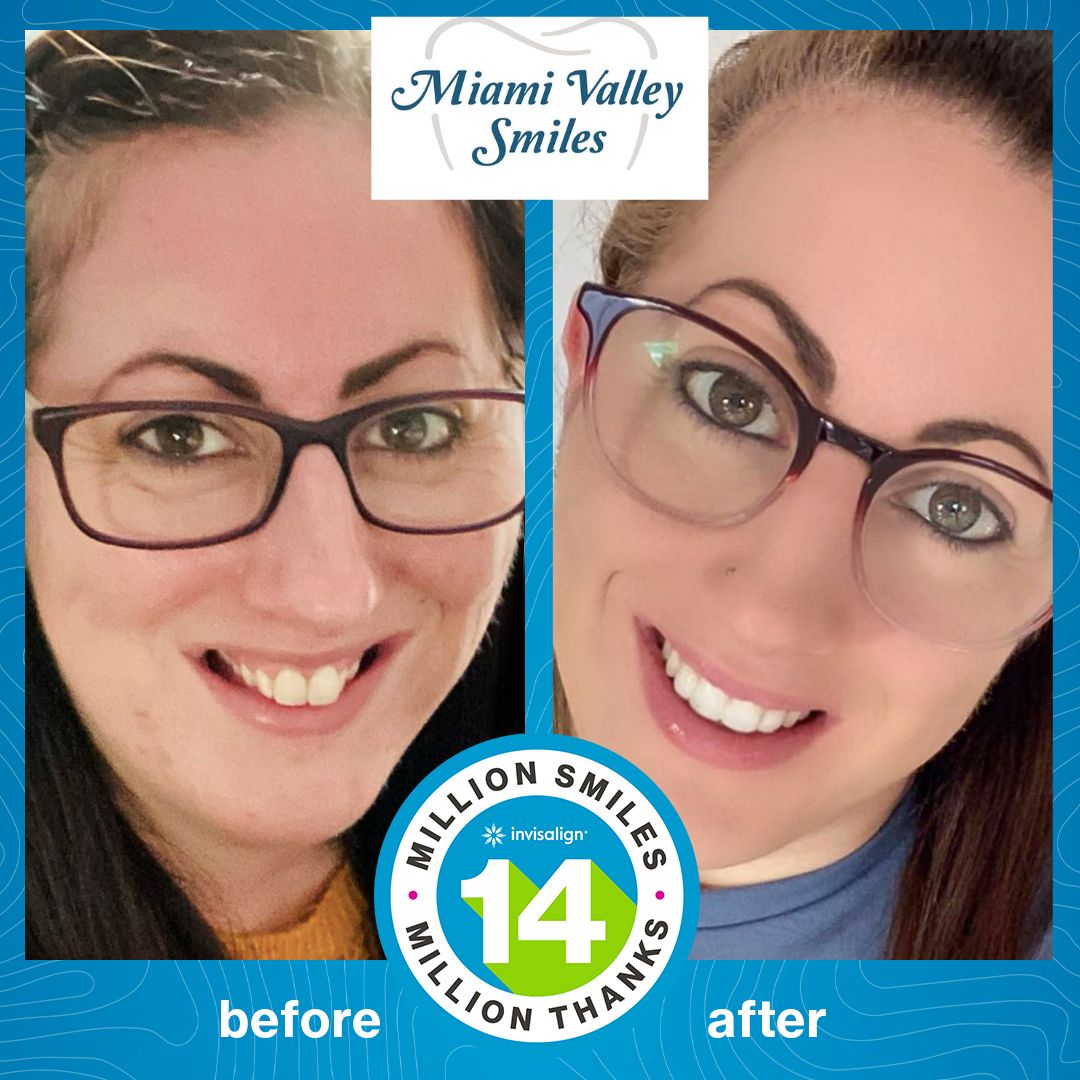 MiamiValleyDDS's tweet photo. Celebrating #WowWednesday with this beautiful #Transformation! If you are interested in Invisalign, contact us today for a free quote! #Invisalign 
https://t.co/bSR7Kg4sLY
513-398-0038 https://t.co/dUGfMxtcKt