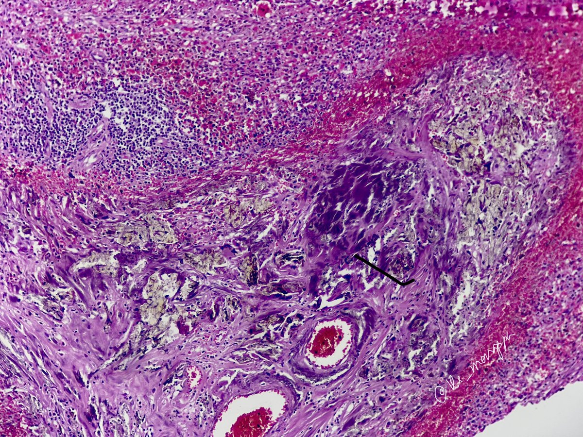 vi_monappa's tweet photo. #pathbasics #beautyinbenign #pathresidents #pathtwitter #medtwitter When they are so pretty that u have to share it ☺️ https://t.co/VFAW6EUXC7