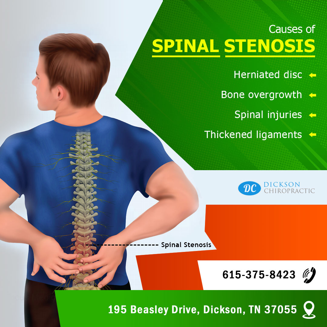 D_Chiropractic's tweet photo. Spinal Stenosis can cause problems with your spine. Learn how chiropractic care can help at https://t.co/IMe2d9ftwf 

#spinalstenosis #spinecare #chiropractic https://t.co/O2I3GtZndr