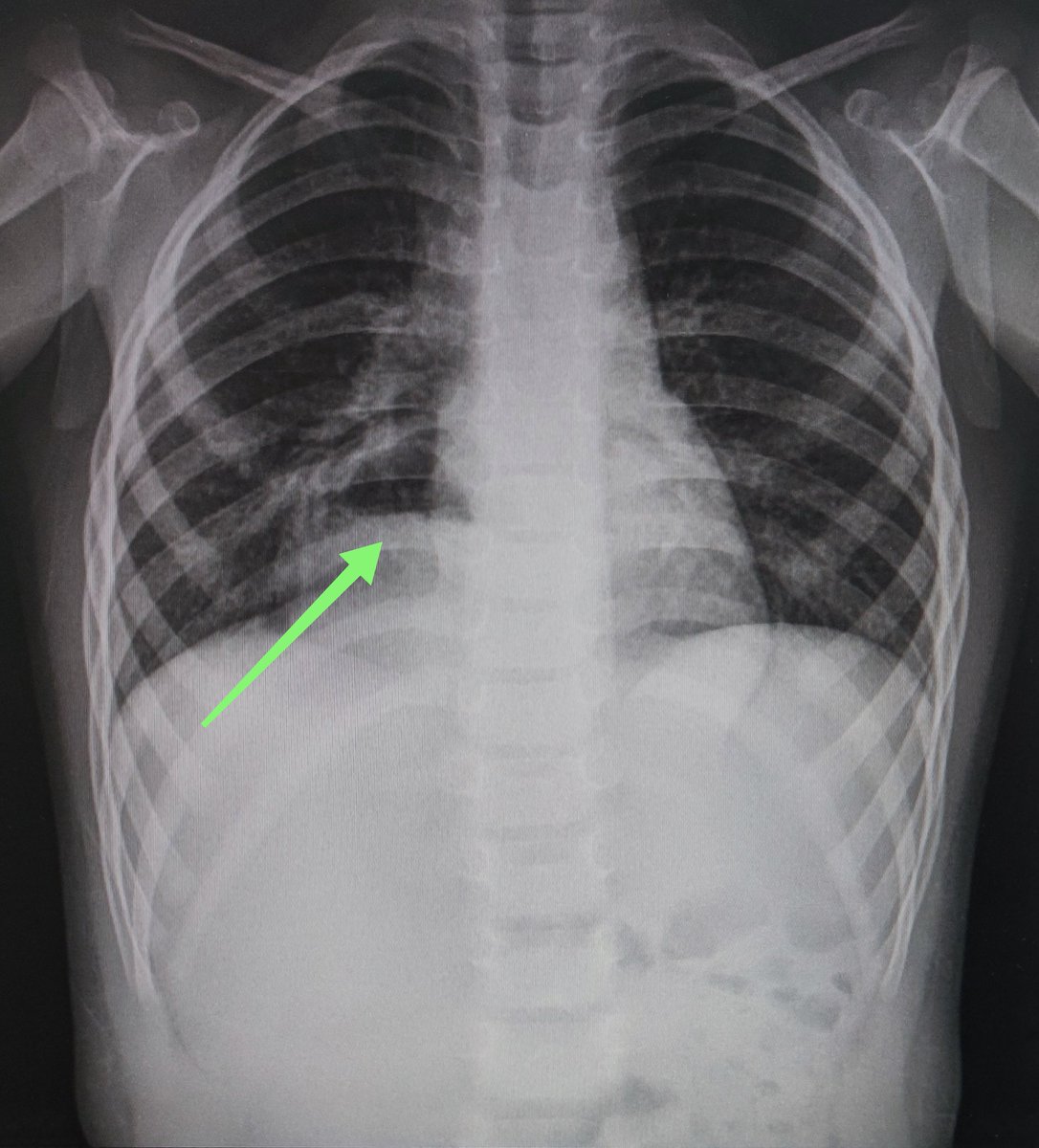 LaLoTomas3's tweet image. Hernia diafragmática derecha en 👶🏼 con síndrome de heterotaxia visceral (dextroisomerismo).

La flecha señala nivel hidroaéreo que corresponde a cámara gástrica.

@CardioCaribeMx