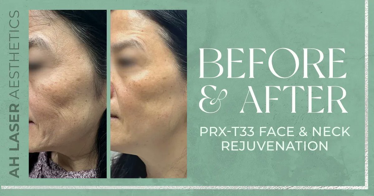 AHLaser's tweet photo. ⚡ PRX-T33 Face &amp; Neck #Rejuvenation

Benefits:
✨ Treats sun damage and age spots
✨ A series of 4 treatments spaced 1 week apart
✨ $1200

Post-procedure tips:
🧴 Apply sunscreen
🧼 Gently cleanse your face

Visit our website to learn more!

💻 https://t.co/VGUXvDU1ip https://t.co/SqvAYgOPCU