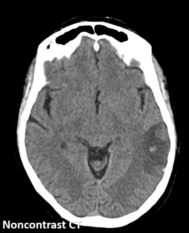 TheAJNR's tweet photo. #AJNRcc >> March 13, 2023 >> What is the diagnosis for this 44-year-old woman with acute onset of confusion, headache, and comprehensive aphasia? Submit your answer at https://t.co/RTHzpVGXte https://t.co/1uhzmKVALr