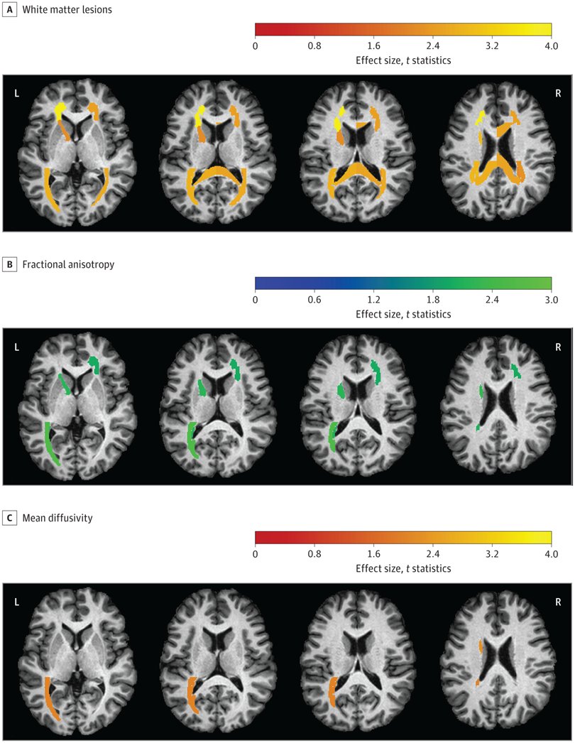 Mohamad Habes (@modhabes) on Twitter photo Delighted to see our paper from the SPRINT trial, showing how intensive hypertension treatment reduces the progression of cerebral small vessel disease ja.ma/3ml77Xu by <a href="/JAMANetworkOpen/">JAMA Network Open</a>. Congrats #TanweerRashid et al. <a href="/UTHSAResearch/">UT Health San Antonio Research</a> <a href="/PennRadiology/">Penn Radiology</a> @Penn_Memory <a href="/sudha_md/">Sudha Seshadri, MD</a> Delighted to see our paper from the SPRINT trial, showing how intensive hypertension treatment reduces the progression of cerebral small vessel disease ja.ma/3ml77Xu by <a href="/JAMANetworkOpen/">JAMA Network Open</a>. Congrats #TanweerRashid et al. <a href="/UTHSAResearch/">UT Health San Antonio Research</a> <a href="/PennRadiology/">Penn Radiology</a> @Penn_Memory <a href="/sudha_md/">Sudha Seshadri, MD</a>