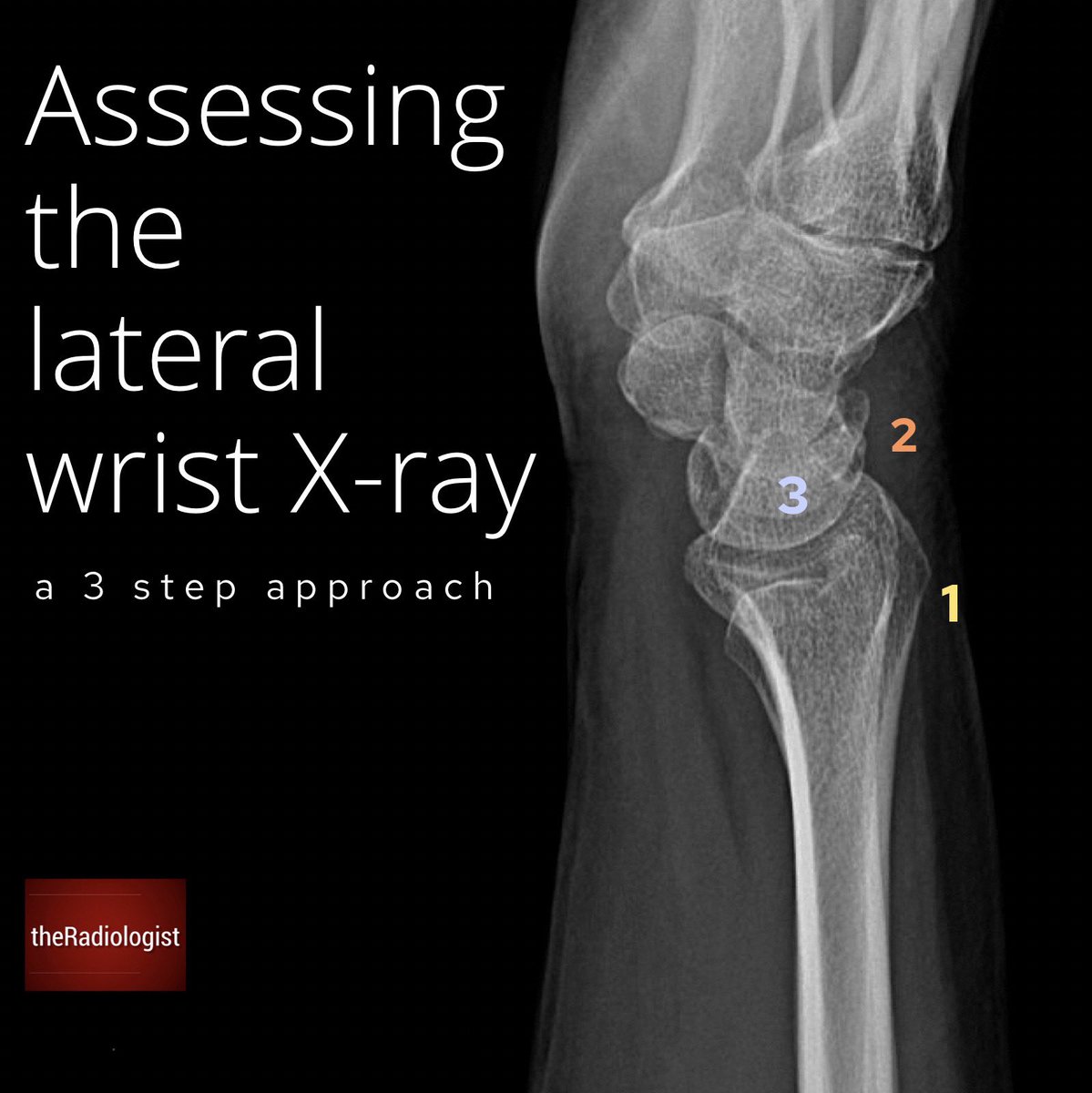 three-review-areas-on-a-lateral-wrist-x-ray-thread-from