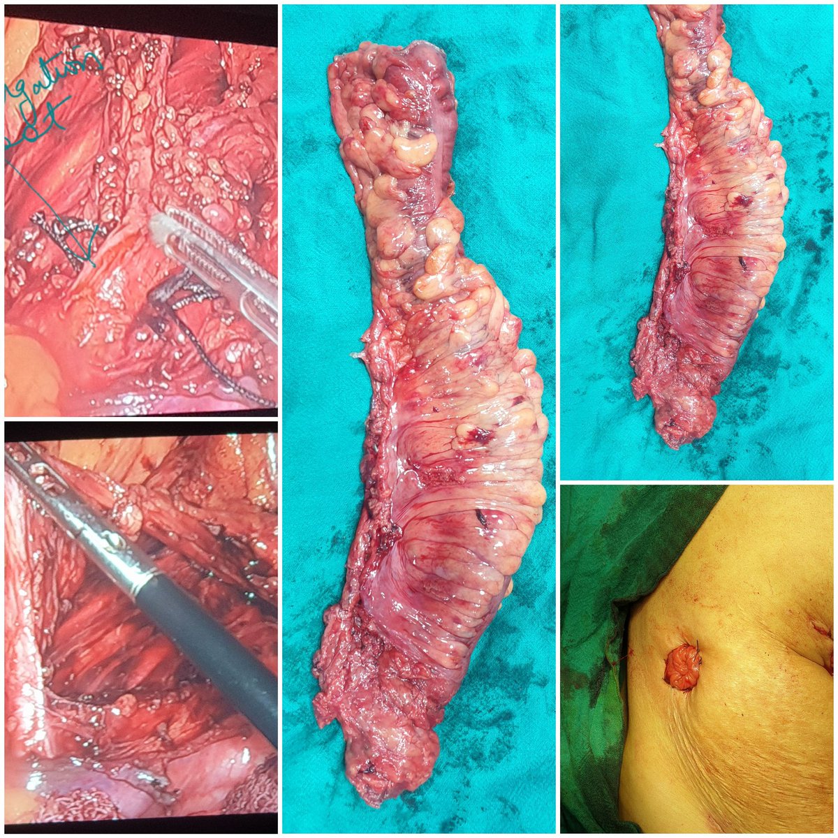 shakeeblone's tweet photo. We at @PrincipalGMCbla performed our first Laparoscopic LAR on a 65 y old female who was diagnosed with rectal cancer. This is an advanced lap surgery performed only in a few tertiary care hospitals in our UT. 
@HealthMedicalE1
@DCBaramulla
@MedTweetorials 
@SWexner @drkeithsiau https://t.co/ManycujN75