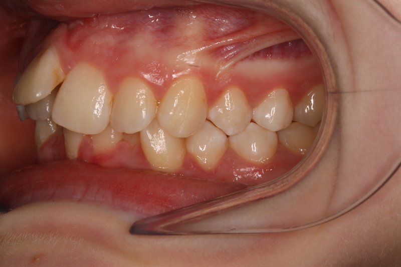 ConfidentOrtho's tweet photo. How amazing is this patients before &amp; after Photos!🤩
Give us a call on 01823 289276 if you are thinking of transforming your smile! 
#transformation #before #after #ortho #orthodontics #orthodontist #orthodonticpractice #newsmile #bookinnow #ConfidentOrthodontics ⭐️ https://t.co/WvekQebMCA