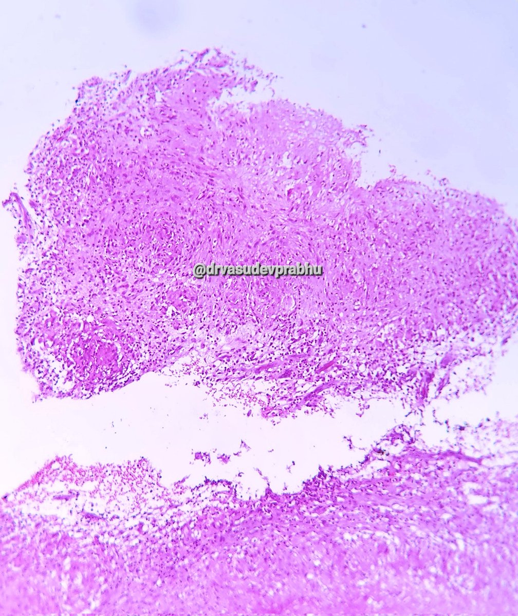 DrVasudevPrabhu's tweet photo. Elderly male with ankle jt. Tenderness, Synovial bx taken,  diagnosis? 🔬 #pathboards #pathspotters #PathTwitter #medtwitter #pathologyresident #teachingpathology @shalinirkr21 @RizviUroos #BSTPath @premcharles @RagaviRamanan @mkpath1617 @DKalodimou @saray_gonul @ArvindKhanijo https://t.co/rqM0Pafjh5