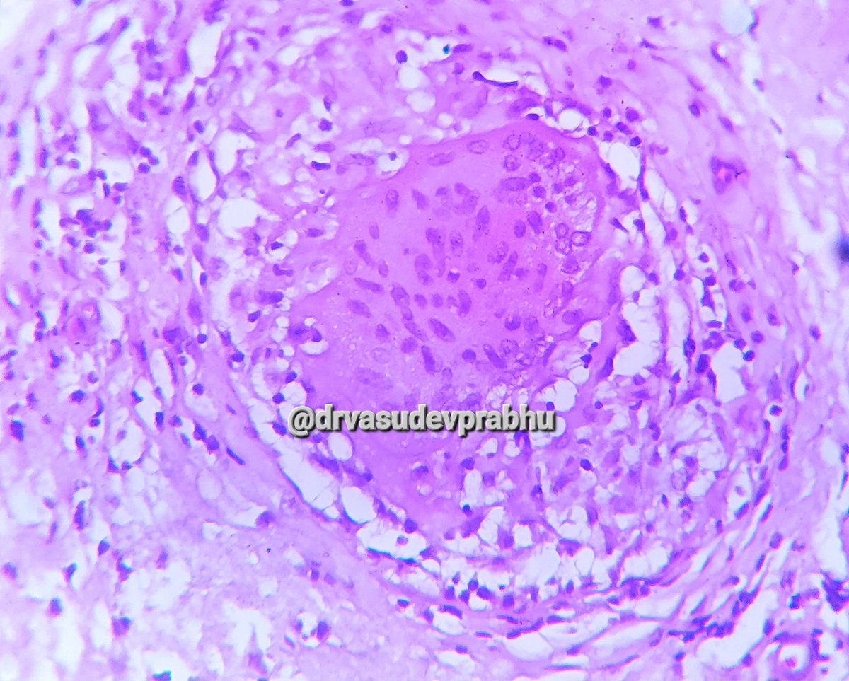 DrVasudevPrabhu's tweet photo. Elderly male with ankle jt. Tenderness, Synovial bx taken,  diagnosis? 🔬 #pathboards #pathspotters #PathTwitter #medtwitter #pathologyresident #teachingpathology @shalinirkr21 @RizviUroos #BSTPath @premcharles @RagaviRamanan @mkpath1617 @DKalodimou @saray_gonul @ArvindKhanijo https://t.co/rqM0Pafjh5