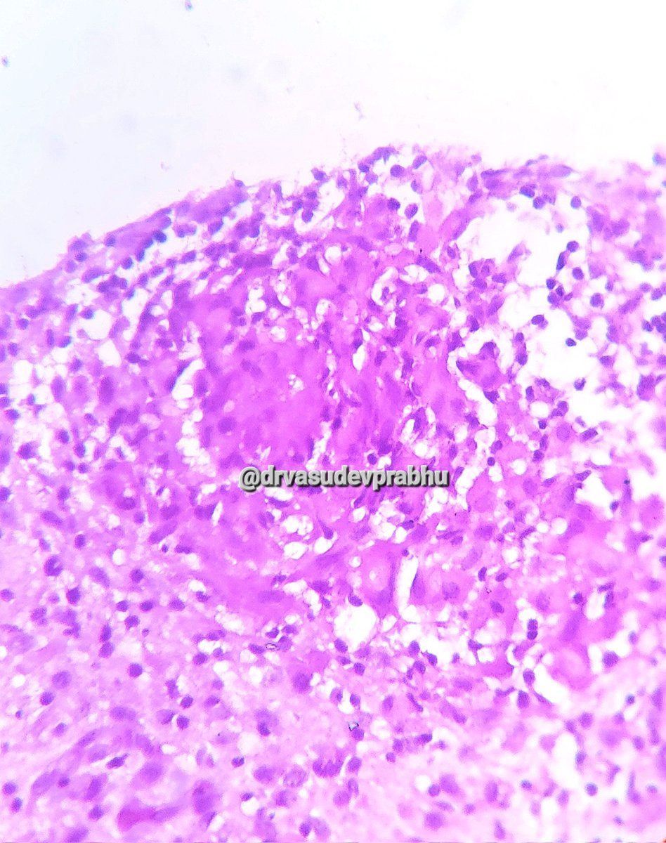 DrVasudevPrabhu's tweet photo. Elderly male with ankle jt. Tenderness, Synovial bx taken,  diagnosis? 🔬 #pathboards #pathspotters #PathTwitter #medtwitter #pathologyresident #teachingpathology @shalinirkr21 @RizviUroos #BSTPath @premcharles @RagaviRamanan @mkpath1617 @DKalodimou @saray_gonul @ArvindKhanijo https://t.co/rqM0Pafjh5