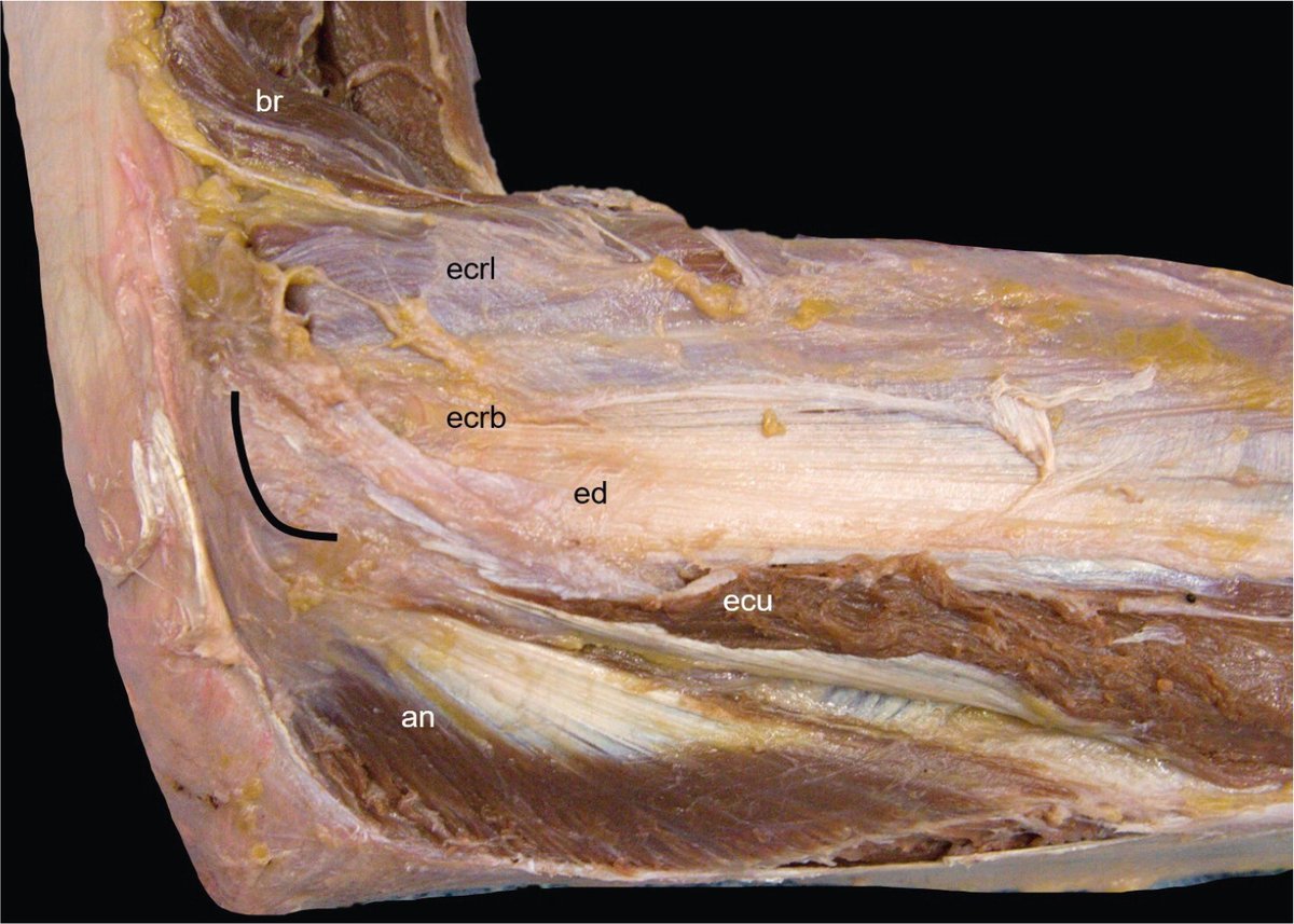 Rheumatology's tweet photo. In this article, we discuss exemplary sonographic pathologies of the elbow, highlighting important structures that should be systematically examined in the corresponding elbow region. Thank you @riccivincenzo17 for the great support
https://t.co/H9pta71vgW https://t.co/3yKbkljQ4Y