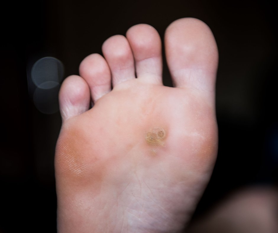 RossSCohenDPM's tweet photo. Calluses and corns might not be painful, but they sure are aggravating! Skip the at-home treatments and get professional care at The Foot and Ankle Center of Maryland. Give us a call today to learn more! https://t.co/itOVp8apGL https://t.co/PEZ8xEijLQ