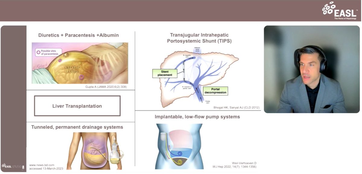 So which new solutions exist for patients with #ascites? 

<a href="/EASLNews/">EASLnews</a> 
#LiverTwitter #EASLStudio