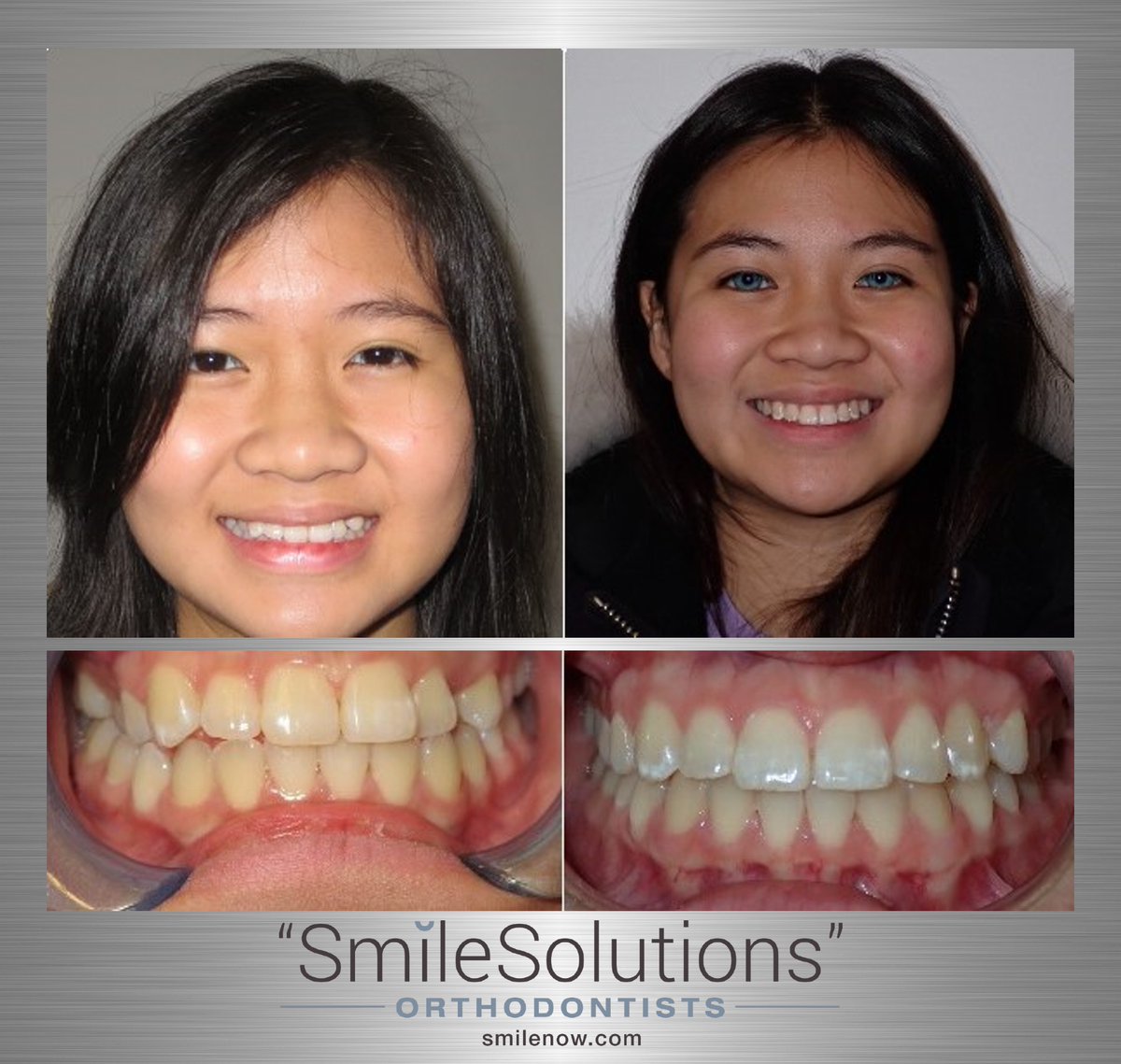 #bracesoff #bracesbrampton #bracesmississauga #orthodontistbrampton #orthodontistmississauga #invisalignbrampton #invisalignmississauga #smilesolutions #smilenow