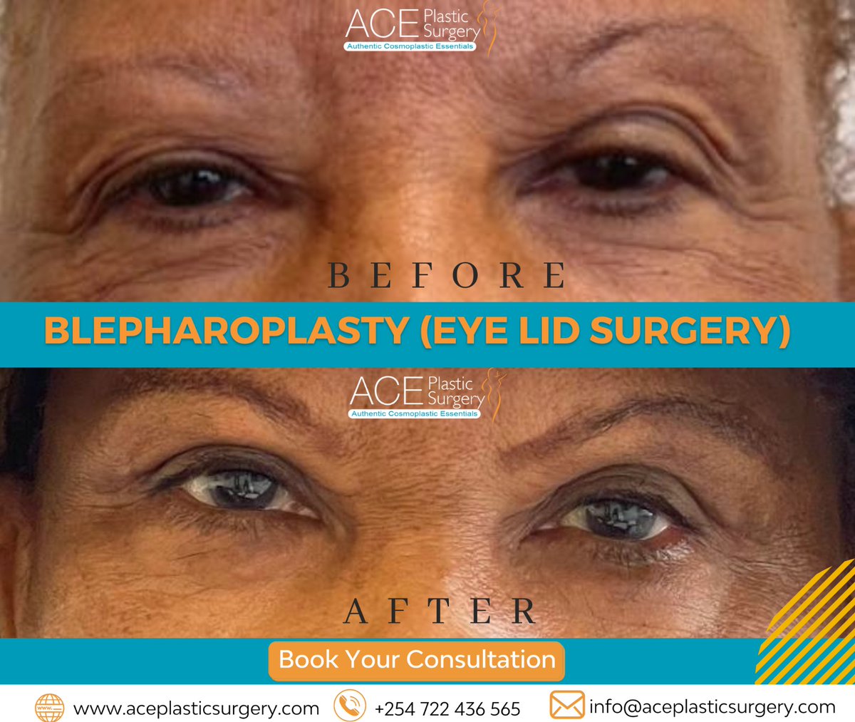 mpowerlimitedke's tweet photo. @aceplastic_surgery - Blepharoplasty is a surgical procedure that removes excess skin, fat, and muscle from the eyelids to improve the appearance of the eyes.

Schedule an appointment today!
Kenya: +254 722 436565
Uganda: +256 783 276169 https://t.co/rZEBFy1RaQ