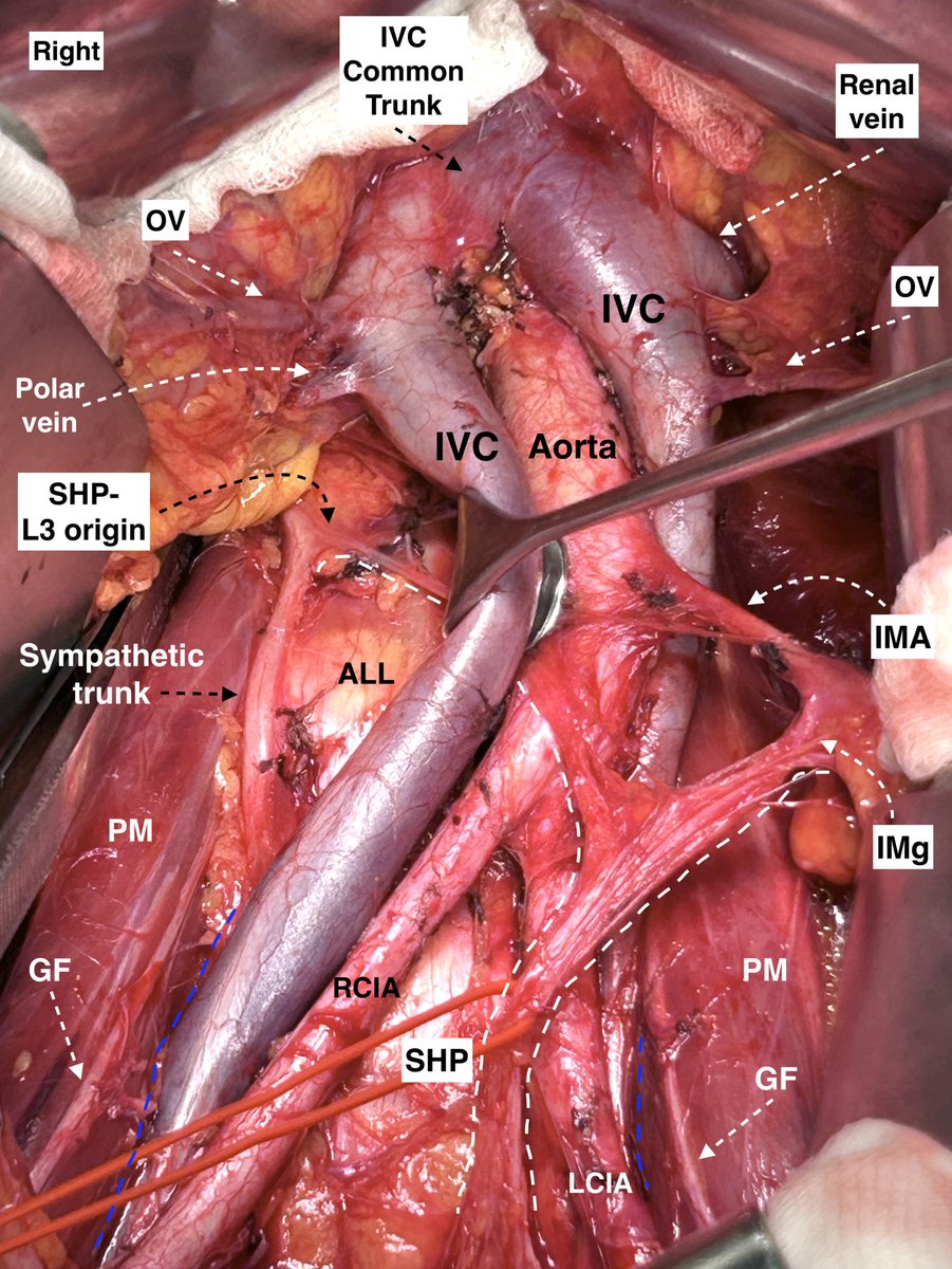 Ilker Selcuk MD PhD (@ilkerselcukmd) on Twitter photo A very very rare vascular retroperitoneal anomaly, 'double inferior vena cava'. We performed nerve sparing paraaortic lymphadenectomy... @Cirbosque <a href="/AnatSciEduc/">Anatomical Sciences Education</a> <a href="/GynMe4/">SoMe4GynOnc</a> <a href="/IJGConline/">IJGC</a> A very very rare vascular retroperitoneal anomaly, 'double inferior vena cava'. We performed nerve sparing paraaortic lymphadenectomy... @Cirbosque <a href="/AnatSciEduc/">Anatomical Sciences Education</a> <a href="/GynMe4/">SoMe4GynOnc</a> <a href="/IJGConline/">IJGC</a>