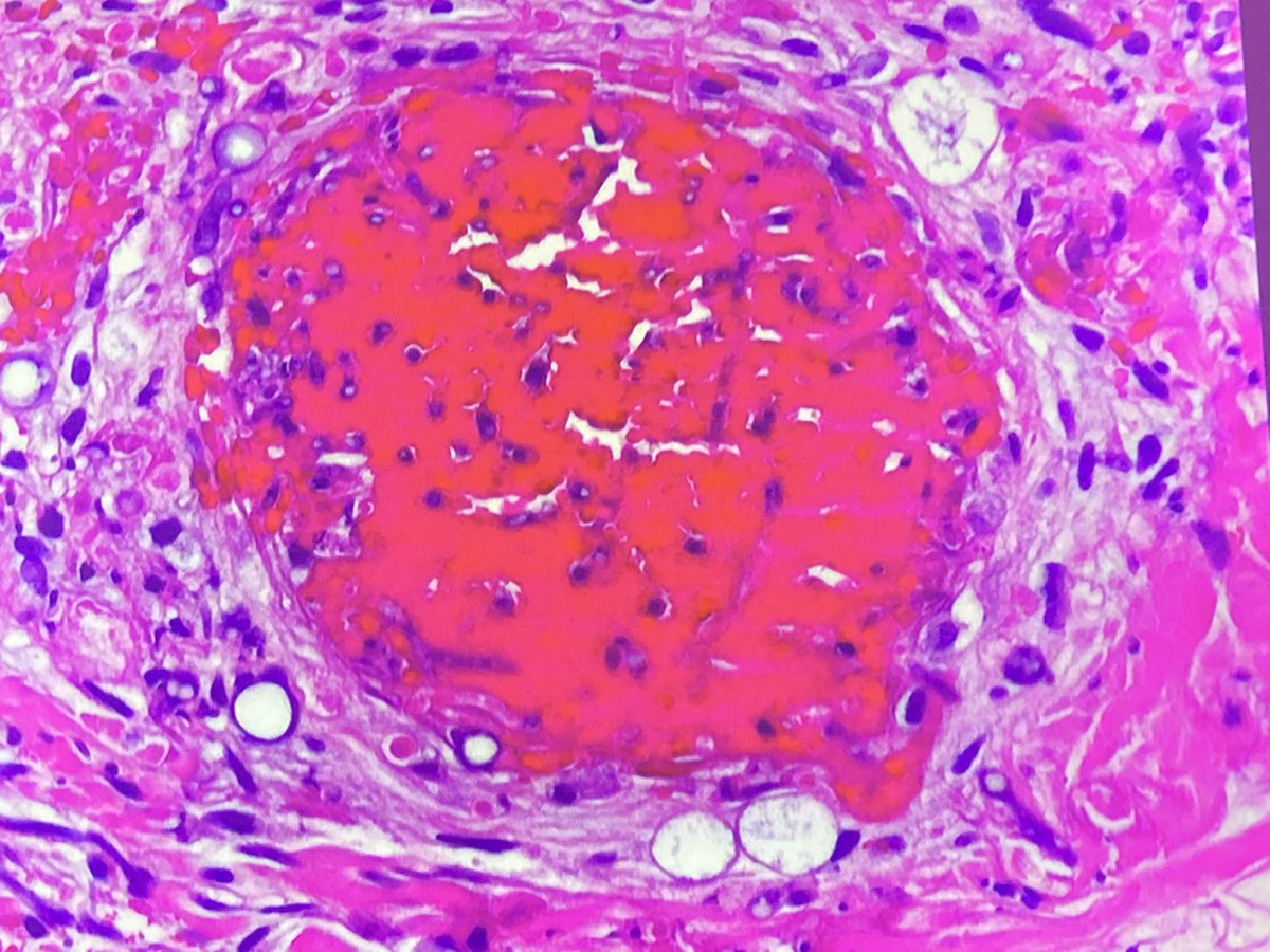 Maite Fdez Figueras (@dermatopatol) on Twitter photo Conidiospores are typical of fusarium and absent in aspergillosis, according to Dr Erlston #ISDP2023 <a href="/GEDP_es/">Grupo Español de Dermatopatología</a> <a href="/SEAP_IAP/">SEAP-IAP</a> <a href="/IntSocDermpath/">Int Soc Dermpath</a> Conidiospores are typical of fusarium and absent in aspergillosis, according to Dr Erlston #ISDP2023 <a href="/GEDP_es/">Grupo Español de Dermatopatología</a> <a href="/SEAP_IAP/">SEAP-IAP</a> <a href="/IntSocDermpath/">Int Soc Dermpath</a>