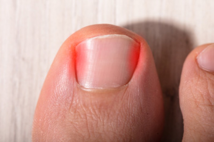 ChicagoSurgeons's tweet photo. Why Do Ingrown Toenails Develop? https://t.co/Y16SD0sf6s https://t.co/FBVt30Hg2J