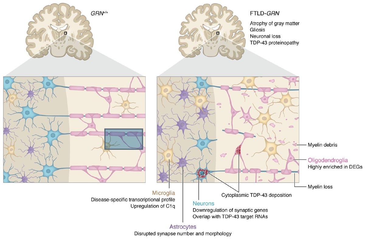 Elise Marsan (@elisemarsan) on Twitter photo Just OUT: A fantastic commentary on our paper by <a href="/EmilePinarbasi/">Emile Pinarbasi</a> & <a href="/BarmadaLab/">Barmada Lab</a>! <a href="/jclinicalinvest/">Journal of Clinical Investigation</a> doi.org/10.1172/JCI168… Thank you so much! Just OUT: A fantastic commentary on our paper by <a href="/EmilePinarbasi/">Emile Pinarbasi</a> & <a href="/BarmadaLab/">Barmada Lab</a>! <a href="/jclinicalinvest/">Journal of Clinical Investigation</a> doi.org/10.1172/JCI168… Thank you so much!