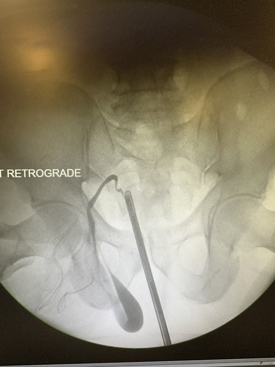 Excellent. Herniation of the ureter into an inguinal hernia is a relatively rare cause of ureteral obstruction. Can be an unpleasant surprise for a general surgeon performing repair and may be injured during that procedure.