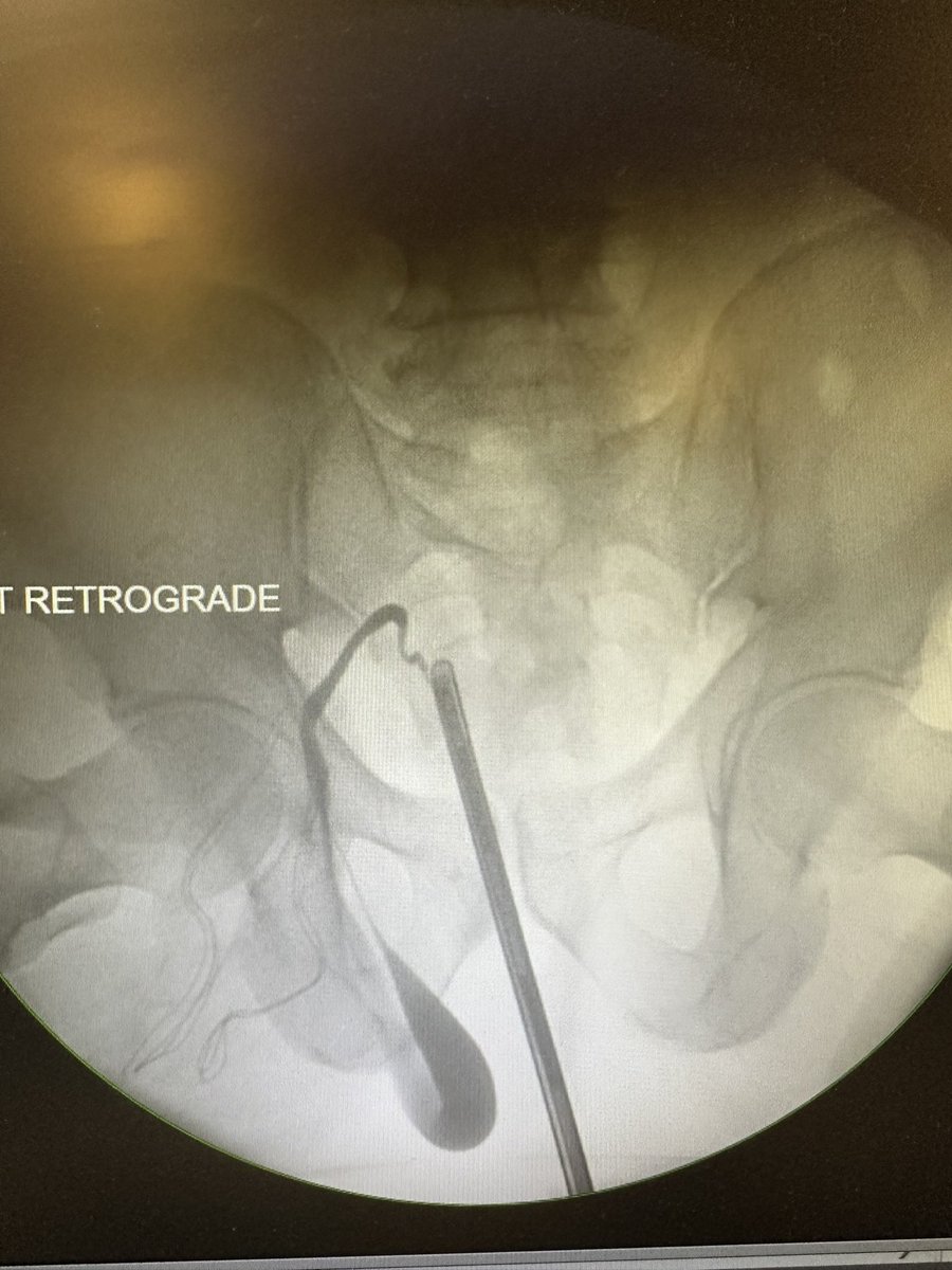 Excellent. Herniation of the ureter into an inguinal hernia is a relatively rare cause of ureteral obstruction.  Can be an unpleasant surprise for a general surgeon performing repair and may be injured during that procedure.