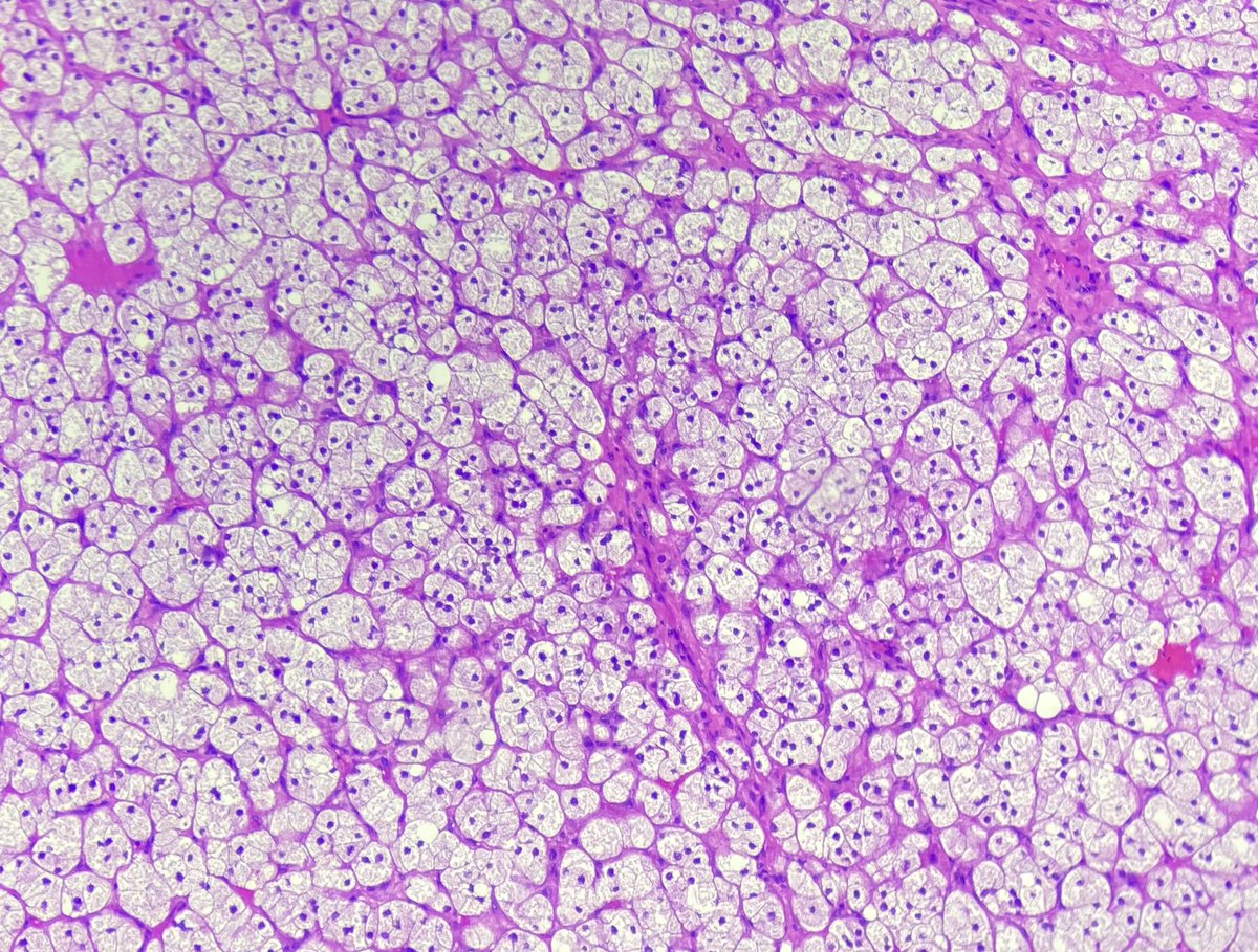 gauriii_23's tweet photo. Unilateral yellow solid ovarian tumour for frozen. She has hirsutism with elevated alpha inhibin levels . #FGTpath #pathology #spotter https://t.co/3Ol9OP7GQR