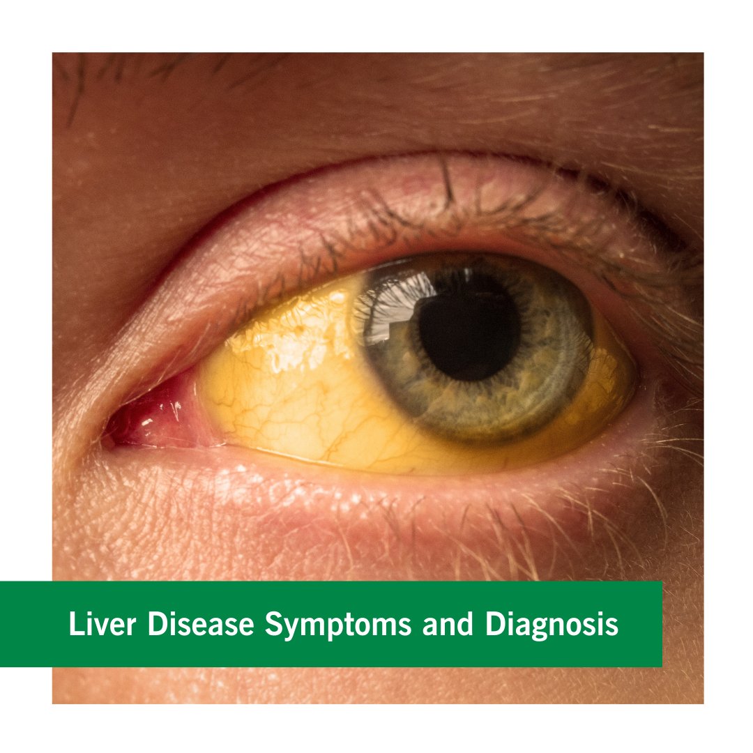 Collection 28+ Stock Photos pictures of yellow eyes from liver damage Full HD, 2k, 4k Collection 28+ Stock Photos pictures of yellow eyes from liver damage Full HD, 2k, 4k