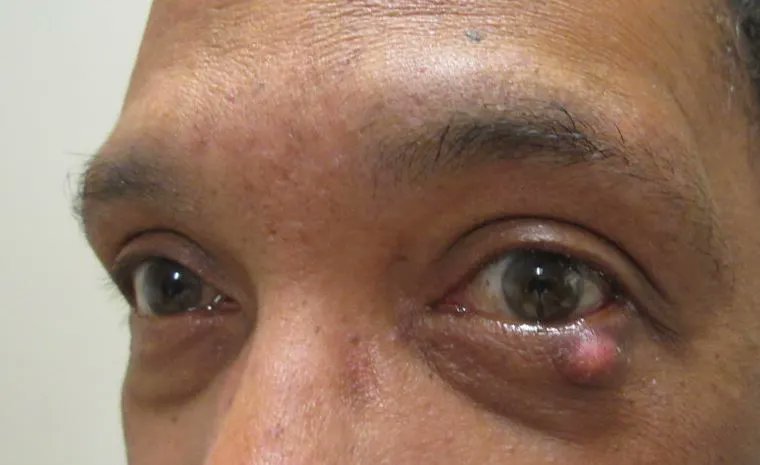 whatisdisease's tweet photo. Chalazion: Symptoms Causes Diagnosis Treatment and Prevention

https://t.co/nmOLeKHqVv https://t.co/6Qum0n8aw8