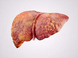 #Cirrhosis is severe scarring of the #liver. This serious condition can be caused by many forms of liver diseases and conditions, such as #hepatitis or #chronic_alcoholism. Visit: scitechnol.com/liver-disease-… Submit research at: scholarscentral.org/submissions/li…