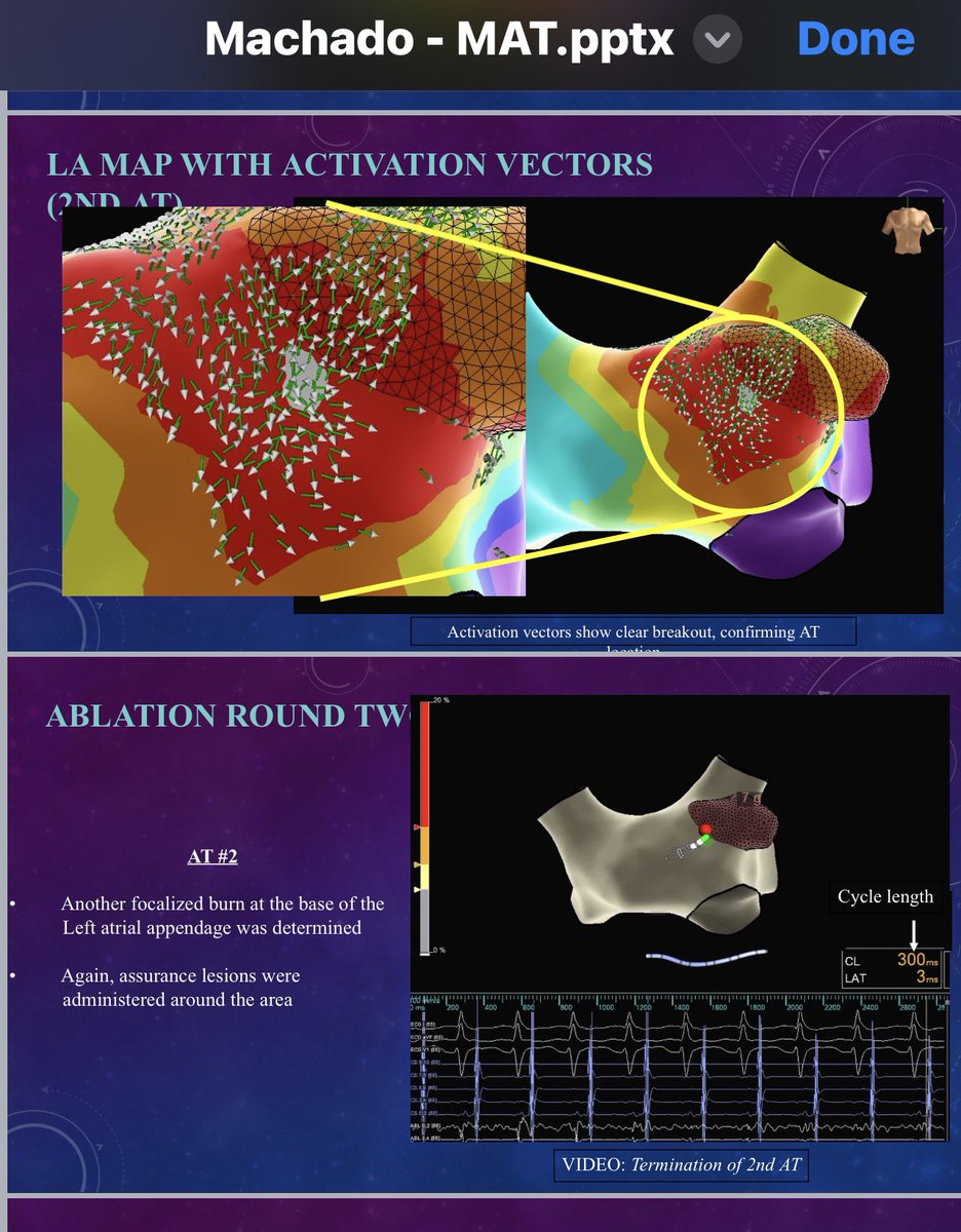 The beauty of mapping with #HDGrid. Pt with multi focal AT found #OnlyWithOT. #EPeeps