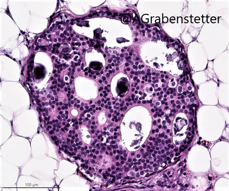 Breast snapshot: Atypical ductal hyperplasia (ADH) 🔬#bcsm #pathtwitter #pathology #breastcancer