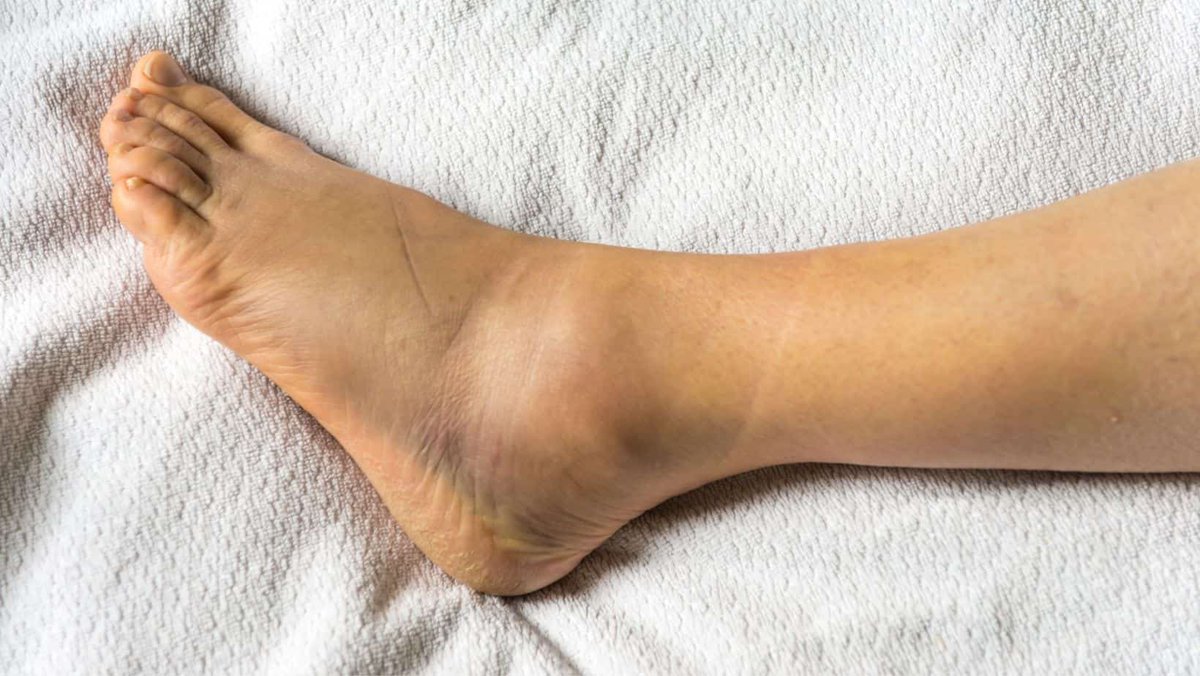 Ankle sprains can be deceptive and your differential may not be as straightforward as it looks on first appearance. 

Let’s explore 3 less common fractures that are worth keeping in mind 1/4 🧵