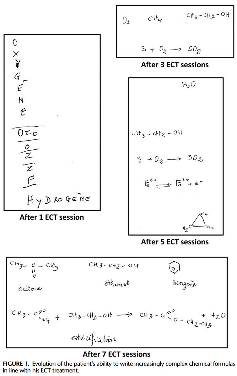cas clinique: améliorations cognitives au cours d'une cure d'ECT pour une catatonie. Pdt la cure, je demandais régulièrement au patient, ancien chimiste, d'écrire sa formule chimique préférée. Le résultat (fig1) est stupéfiant. researchgate.net/publication/36… <a href="/CureLille/">CURE.Lille</a> <a href="/CognitionLille/">Lille Neuroscience & Cognition</a>