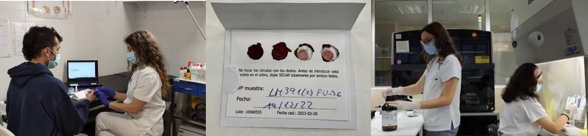 🆕 Researchers evaluated a minimally invasive test based on #DBS for the monitoring of #HCV infection 🩸💊 In a #harmreduction setting, with people who inject drugs 🤝🏽 Co-led by @ElisaMartro @SaSi_Lens 🗞️ Published in the Journal of Medical Virology 🔗 bit.ly/study_hepatiti…