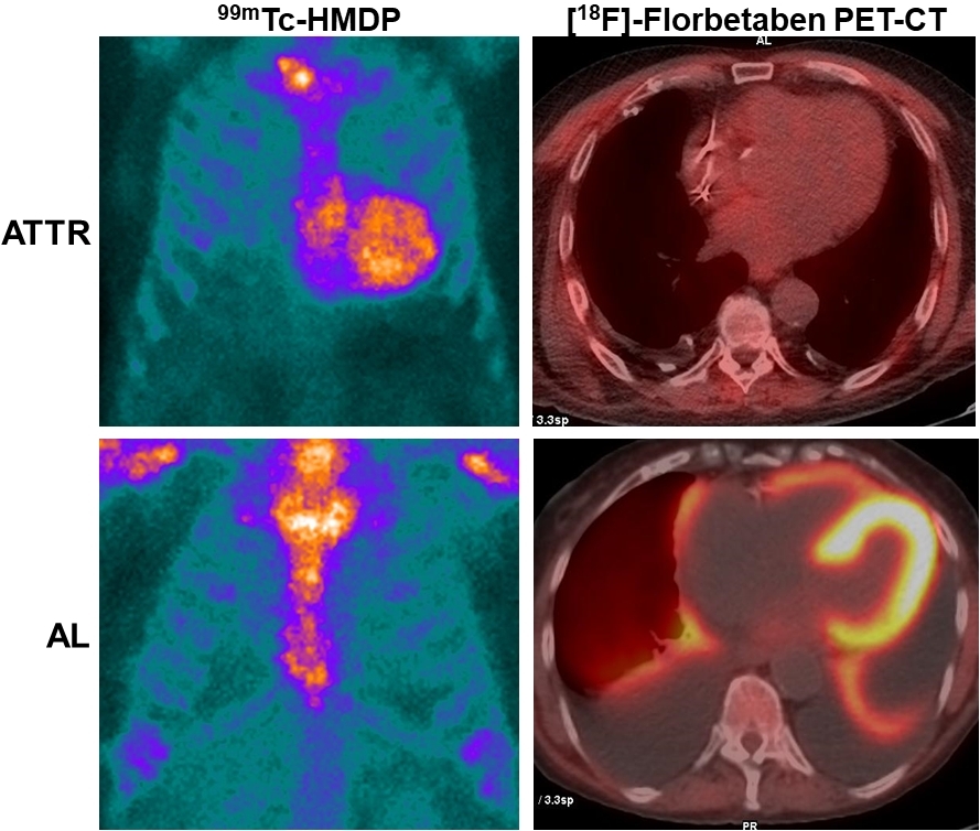 🥳Today's great review!
👨‍💼Title: #Nuclear medicine techniques for the diagnosis of #cardiacamyloidosis: the state of the art
🔓vpjournal.net/article/view/4…
🔖…epublishstorage.blob.core.windows.net/9b186db4-f2e7-…
