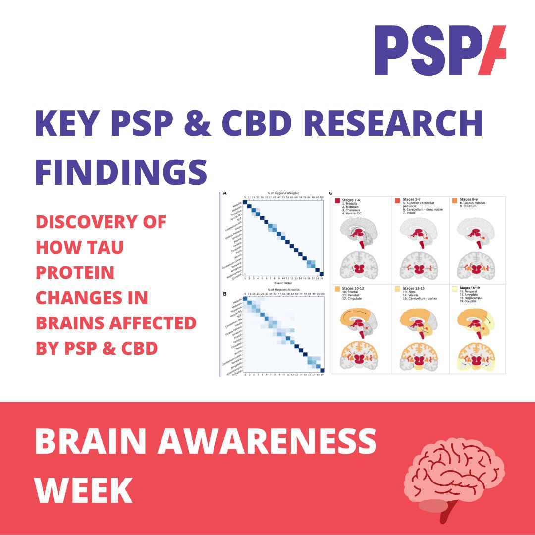 PSPAssociation's tweet image. In PSP &amp;amp; CBD, TAU protein molecules misshapen and disconnect from the tubules, causing instability and TAU clumps known as neurofibrillary tangles. Much research focuses on blocking the development or enhancing the removal of these tangles.

#BrainAwarenessWeek #NeuroKnowledge