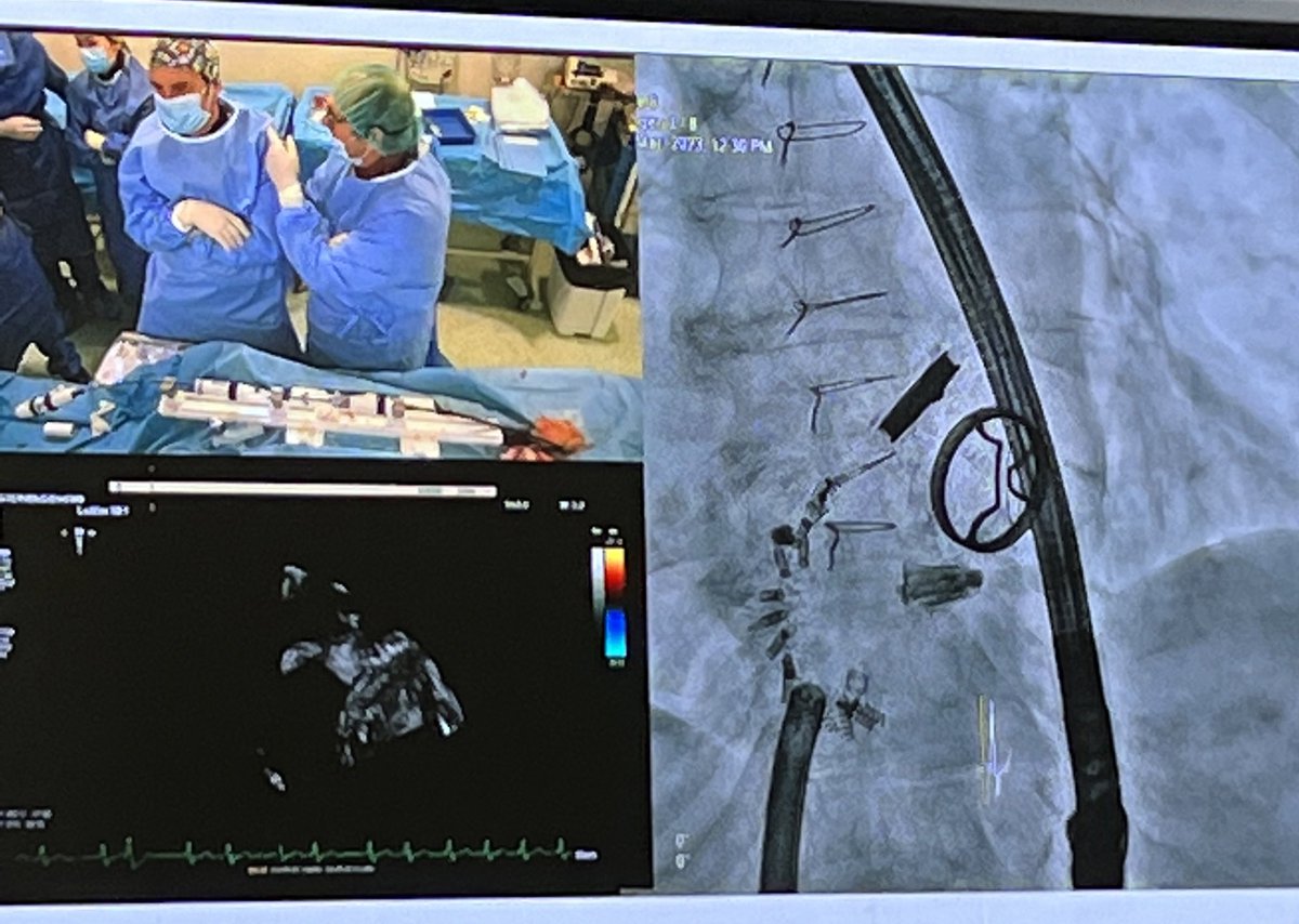 Hemodinamica12O's tweet photo. Paciente con doble prótesis mecánica mitral y aórtica, cardioband tricúspide previo y Pascal en vivo por IT torrencial con los doctores @StructuralBCN y @MPAOSS en #CSC2023. Excelente resultado. Este es el camino de la 🫀 intervencionista de la mano de la imagen. Preciosa imagen https://t.co/vTZHrmDS6H