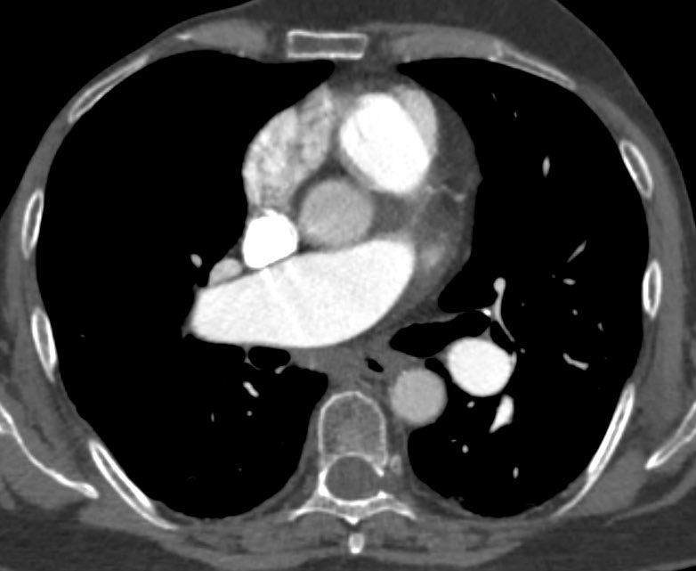 70F with CTEPH

But there is another finding
What is it?

@TLHM_MD 
#FOAMrad #FOAMed #radiology #chestrad