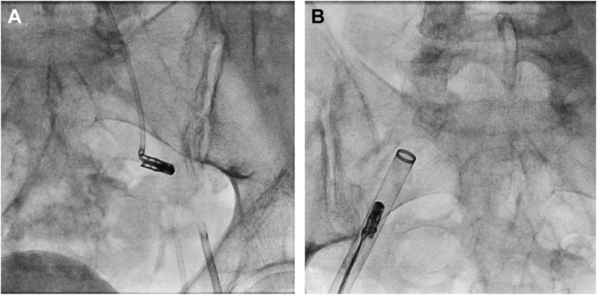 JACC Journals (@jaccjournals) on Twitter photo The first case of successful percutaneous arterial transfemoral retrieval of an embolized clip presenting as an acute inferior #STEMI caused by occlusion of #RCA. bit.ly/3yMEkhL
#JACCCaseReports #TEER #MitraClip #CardioTwitter <a href="/aonbendo/">Aron Bender</a> The first case of successful percutaneous arterial transfemoral retrieval of an embolized clip presenting as an acute inferior #STEMI caused by occlusion of #RCA. bit.ly/3yMEkhL
#JACCCaseReports #TEER #MitraClip #CardioTwitter <a href="/aonbendo/">Aron Bender</a>