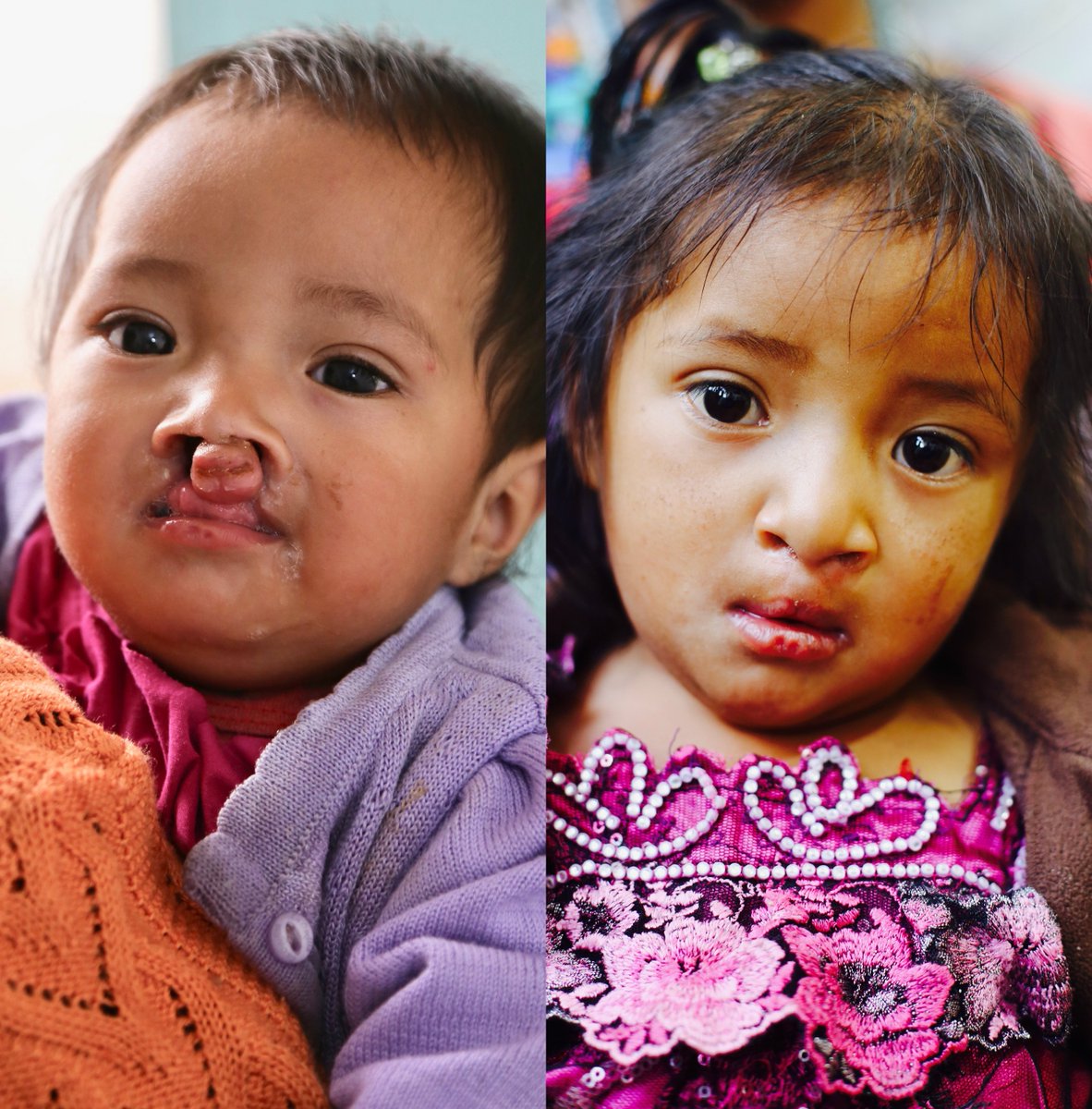TessUnlimited's tweet photo. Sonia's #transformation! Giving children born with #cleftlipandpalate a #newfuture!

Support #tessunlimited and #bethechange

https://t.co/f0fQP55kNN https://t.co/z6rgLUnRhh