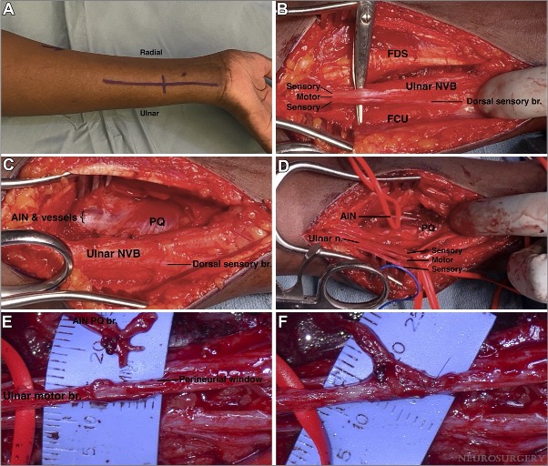 NeurosurgeryCNS's tweet photo. The newest in our #SectionEditorReviewSeries! Reverse End-to-Side Transfer to Ulnar Motor #Nerve: Evidence From Preclinical and Clinical Studies https://t.co/jS3qfceLvU by Pathiyil et al @UCalgary @DKondziolkaCNS @CNS_Update @haboualshaar @LKReedMD @urquiagajf_MD @jh_kanterMD https://t.co/fS5WT5vufn