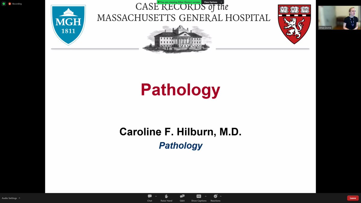 Emilio Madrigal, DO (@emadrigaldo) on Twitter photo Current <a href="/MGHPathology/">MGH Pathology</a> #cytoPath fellow, Dr. <a href="/HilburnCaroline/">Caroline Hilburn</a> presenting today's <a href="/NEJMCPC/">NEJM CPC</a> π Current <a href="/MGHPathology/">MGH Pathology</a> #cytoPath fellow, Dr. <a href="/HilburnCaroline/">Caroline Hilburn</a> presenting today's <a href="/NEJMCPC/">NEJM CPC</a> π